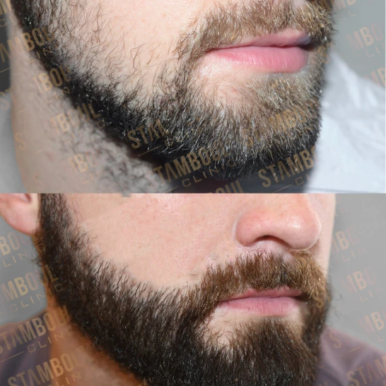 Barttransplantation Vorher-Nacher