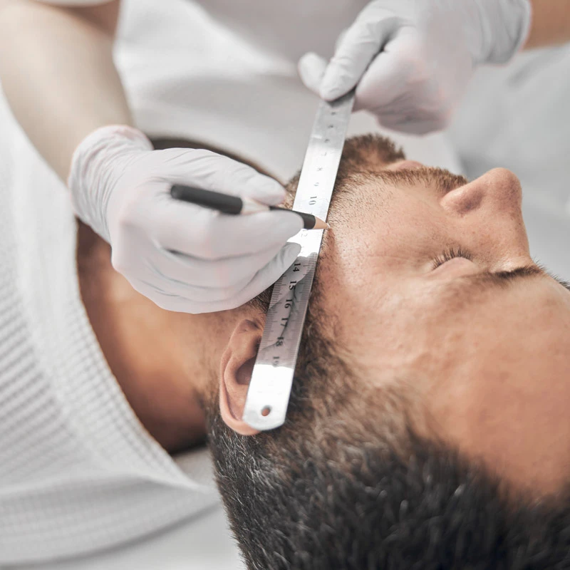 Wie lange dauert eine Barttransplantation?