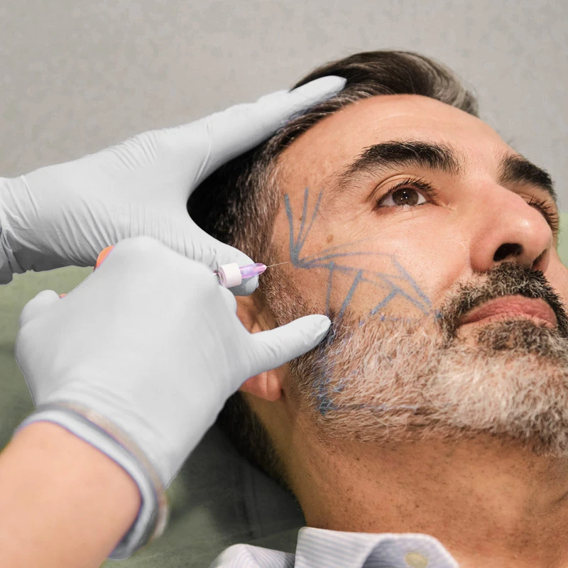  Was ist eine Barttransplantation?