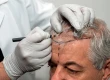 Was ist die beste Methode für eine Haartransplantation?