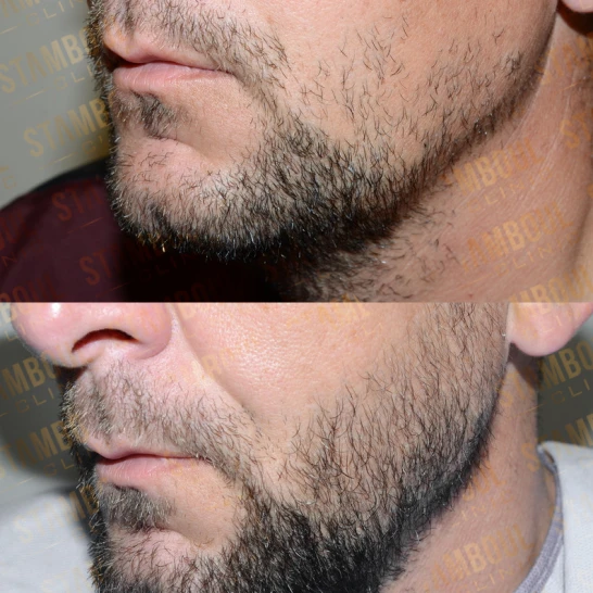 Barttransplantation Vorher-Nacher