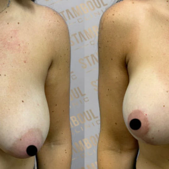 Bruststraffung Vorher-Nacher
