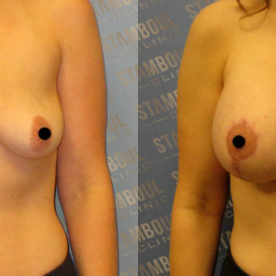 Bruststraffung Vorher-Nacher