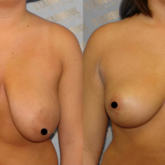 Bruststraffung Vorher-Nacher