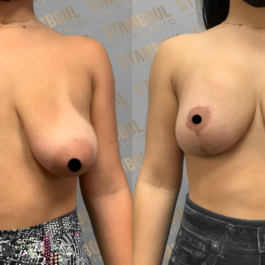 Bruststraffung Vorher-Nacher