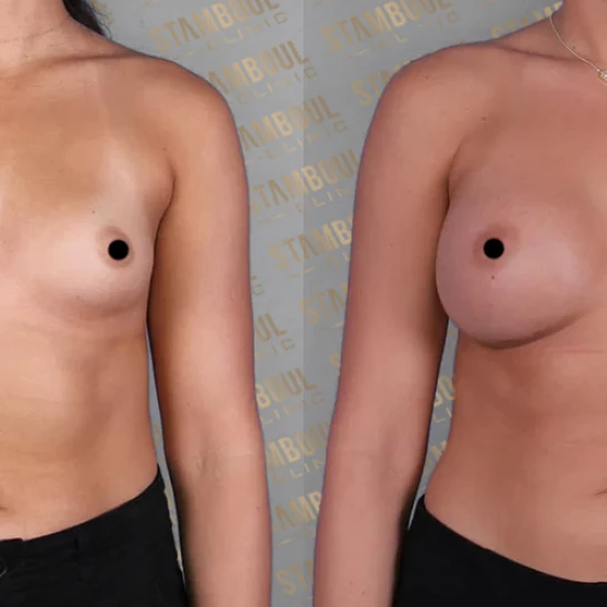 Breast Fat Injection Before After