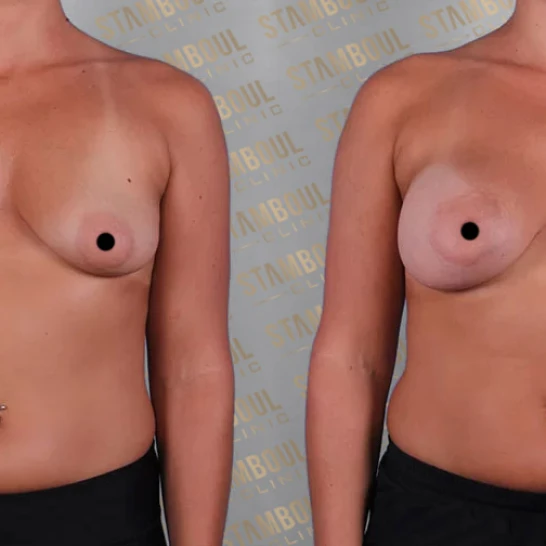 Breast Fat Injection Before After