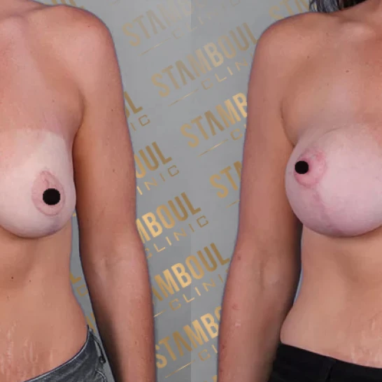 Brustkorrektur-Operation Vorher-Nacher