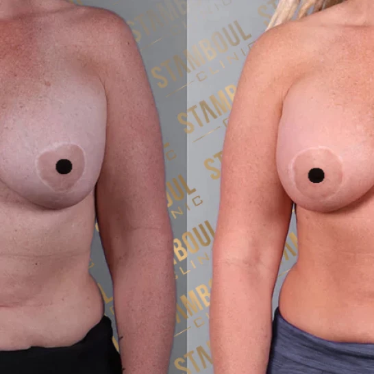 Brustkorrektur-Operation Vorher-Nacher
