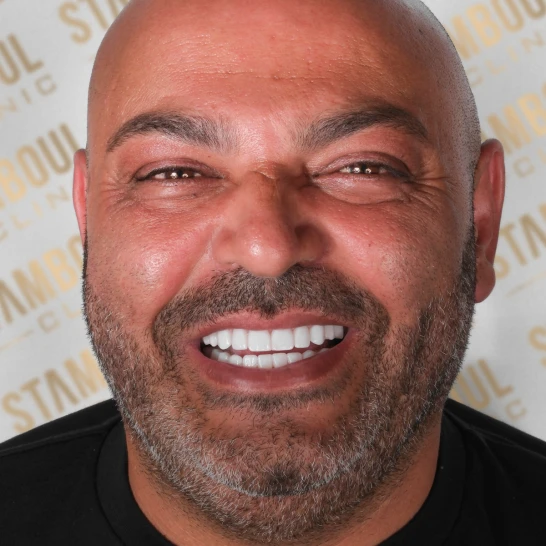 Porzellankronen Vorher-Nacher