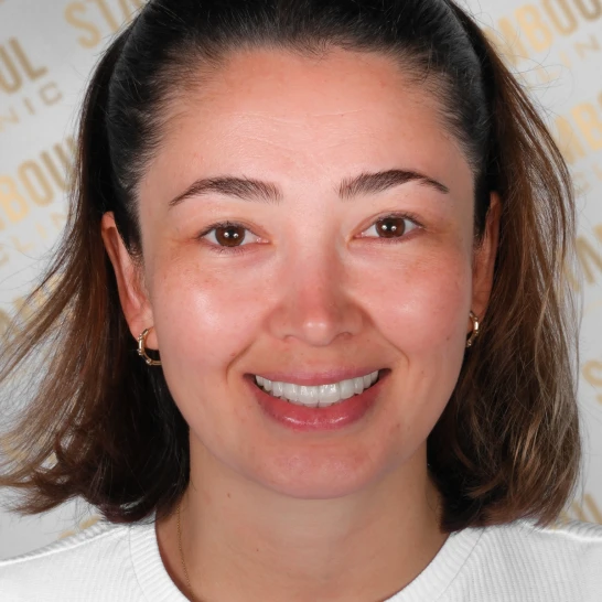 Porzellankronen Vorher-Nacher