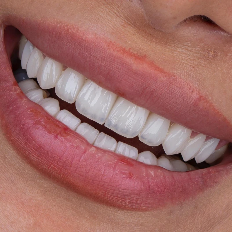 Was sind Zahnverblendungen?