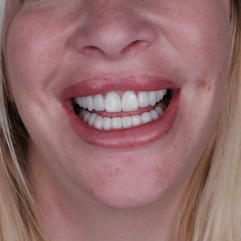 Wie läuft eine Porzellankronen-Behandlung ab?