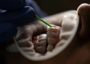 Wie Viel Kostet Ein Hollywood-Lächeln Typischerweise?