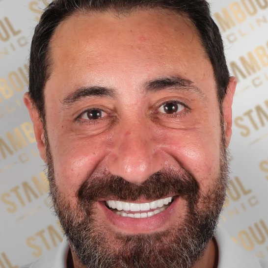 Zahnverblendungen Vorher-Nacher