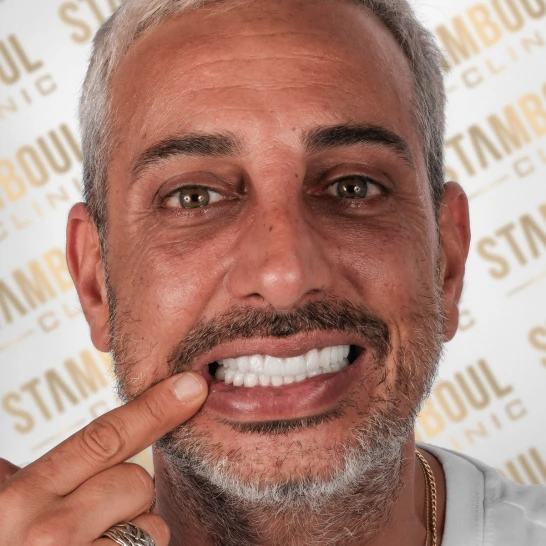 Zahnverblendungen Vorher-Nacher