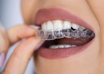 Transparente Zahnschienen (Invisalign)