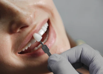 Veneers Türkei Kosten im Überblick