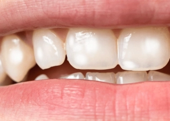 Dişteki Beyaz Leke Nasıl Geçer? Neden Oluşur?