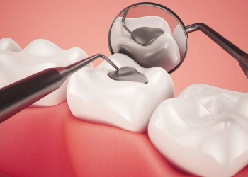 Can You Be Allergic to Dental Fillings? Causes, Symptoms, and Safe Alternatives