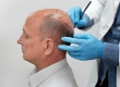 10 Critical Things You Must Know Before Getting a Hair Transplant