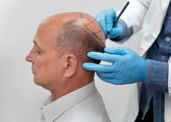 10 Critical Things You Must Know Before Getting a Hair Transplant