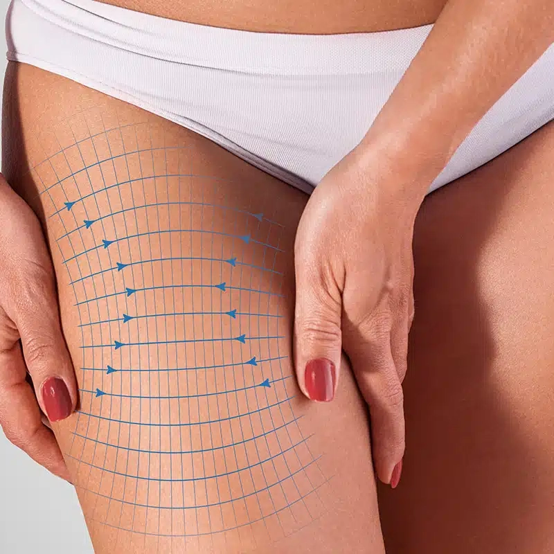 How Does the Thigh Lift Work?