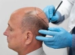 What Precautions Should Be Taken After a Hair Transplant?