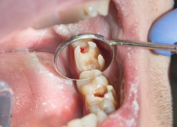 How to Get Rid of Tooth Sensitivity? What Causes Sensitive Teeth?