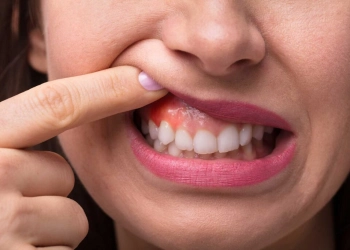 Was verursacht juckendes Zahnfleisch?