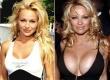 Pamela Anderson Breast Augmentation: Iconic Boob Job