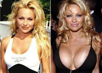 Pamela Anderson Brustvergrößerung: Die ikonische Boob-Job-Geschichte
