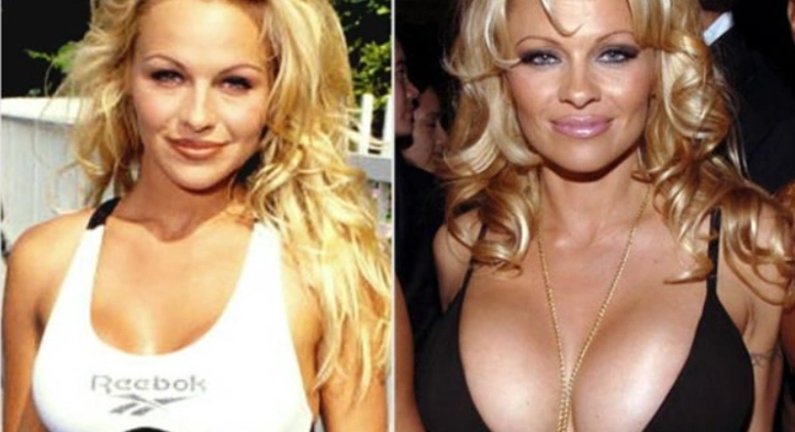 Pamela Anderson Brustvergrößerung: Die ikonische Boob-Job-Geschichte