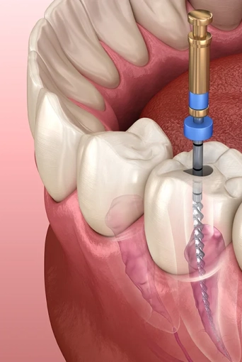 Wie erkennt man eine fehlgeschlagene Wurzelkanalbehandlung? Was sind die Folgen?