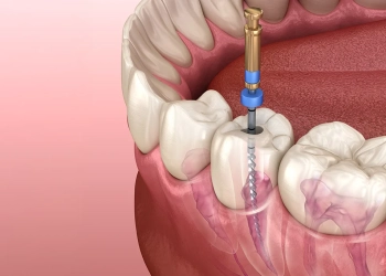 How to Recognize a Failed Root Canal Treatment? What Are the Consequences?