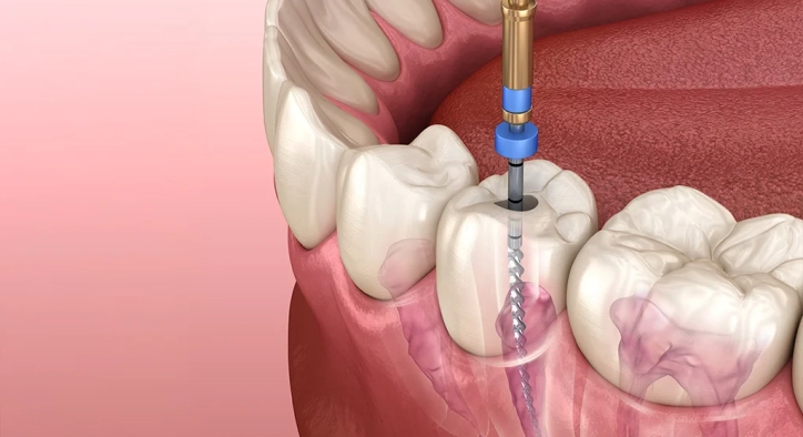 How to Recognize a Failed Root Canal Treatment? What Are the Consequences?