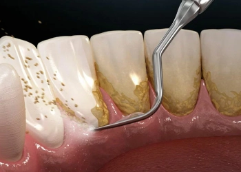 Wie kann man Zahnstein ohne Zahnarzt entfernen?