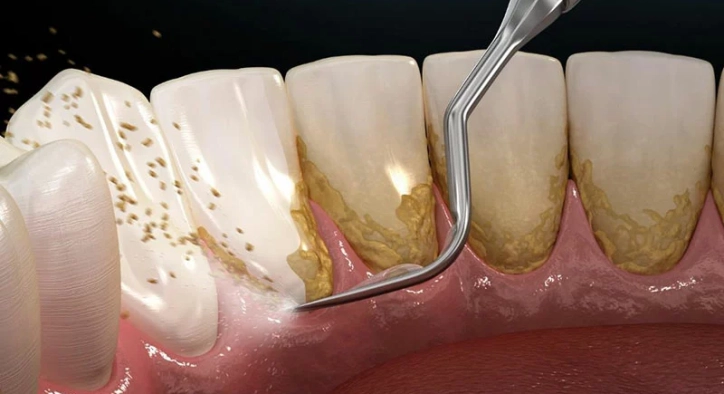 Wie kann man Zahnstein ohne Zahnarzt entfernen?