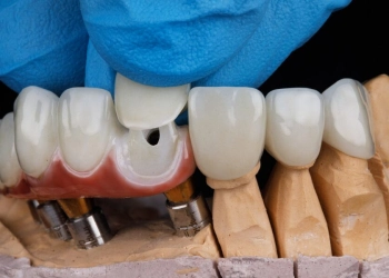 What Precautions Should Be Taken After Tooth Preparation?