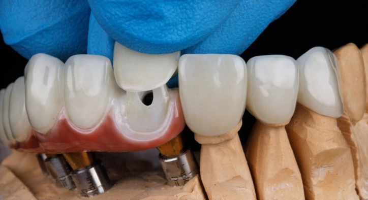 Welche Vorsichtsmaßnahmen sollten nach der Zahnpräparation getroffen werden?