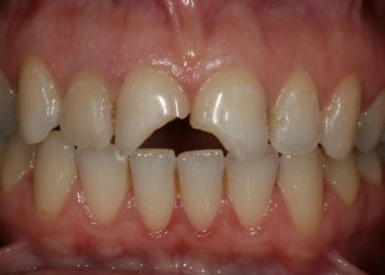 What Should Be Considered After Tooth Cutting?