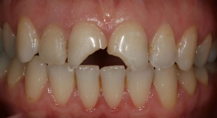 What Should Be Considered After Tooth Cutting?