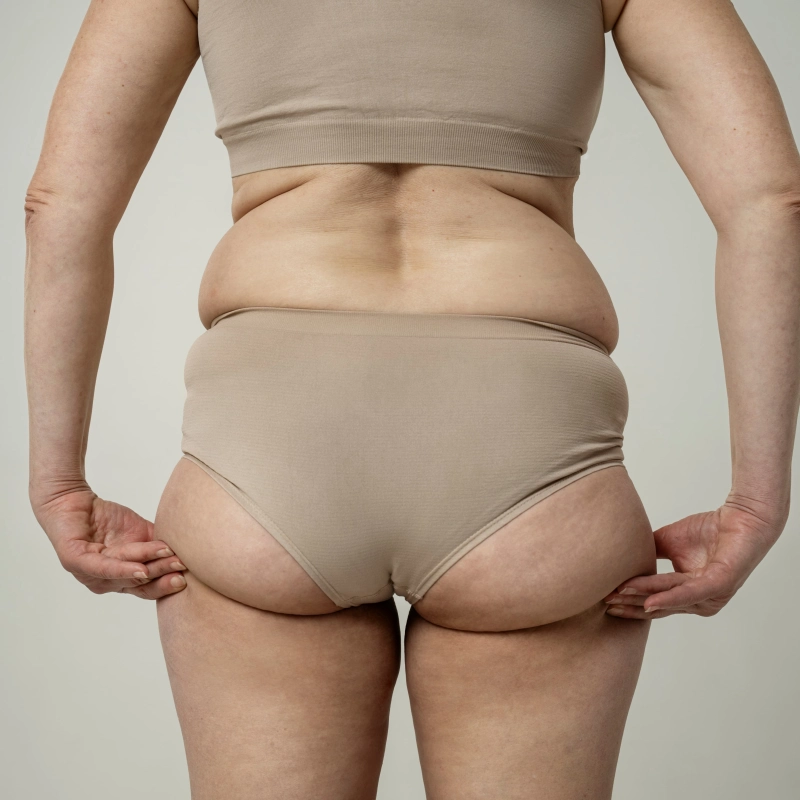 What Is a Thigh Lift?