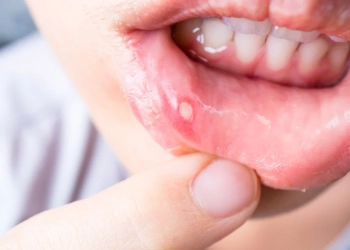 Aphthous Ulcer Guide: Ursachen, Symptome & Expertenbehandlungen