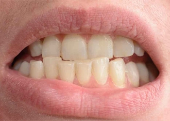 Zahnverschiebung: Wichtige Anzeichen, die Sie niemals ignorieren sollten