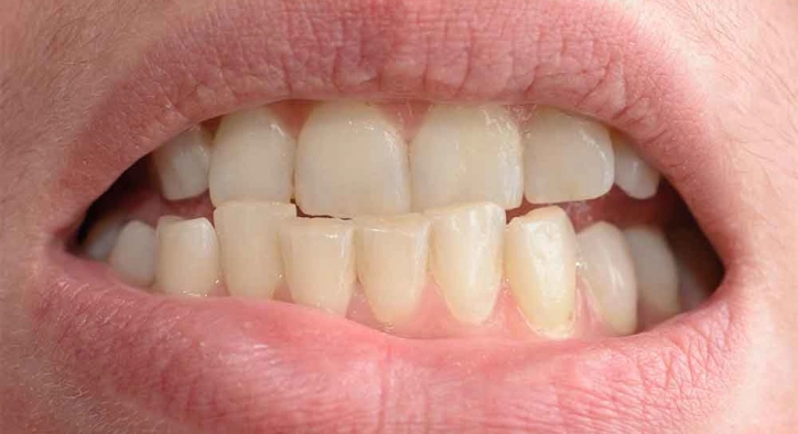 Zahnverschiebung: Wichtige Anzeichen, die Sie niemals ignorieren sollten