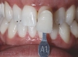 Leitfaden für E-Max-Zahnveneers: Kosten, Vorteile & Verfahren