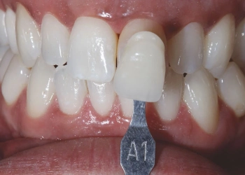 Leitfaden für E-Max-Zahnveneers: Kosten, Vorteile & Verfahren