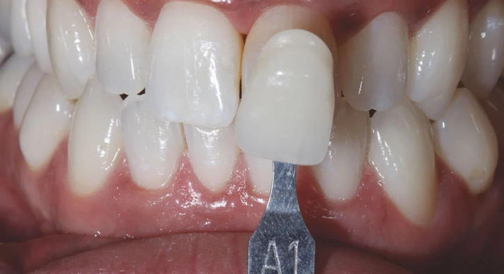 Dental Veneers E-max Guide: Costs, Benefits & Procedure