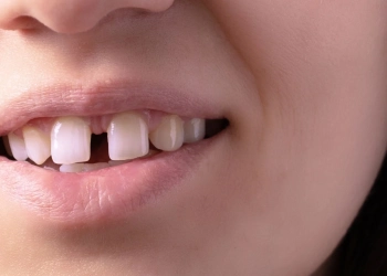 Zahnlückenbehandlung: Kosten, Veneers & Moderne Lösungen 2026
